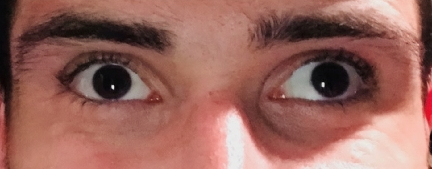 strabisme-alternant-divergent-ou-convergent