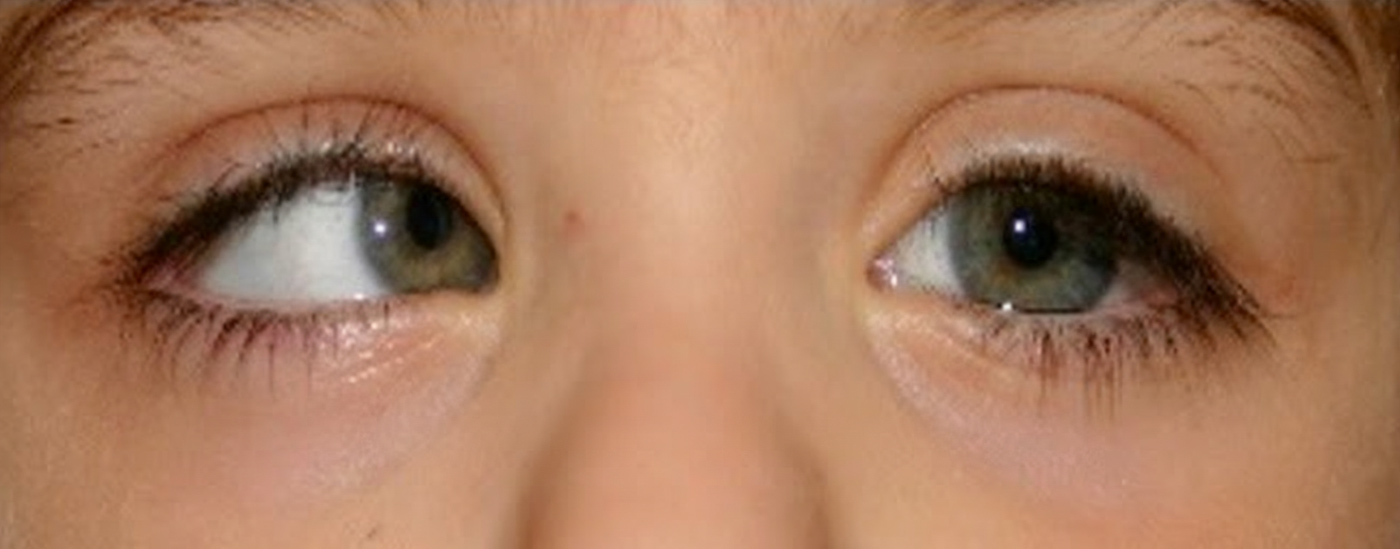 strabisme-convergent