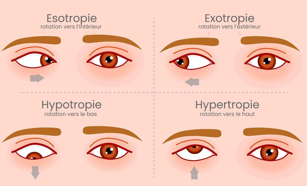 strabisme-illustration